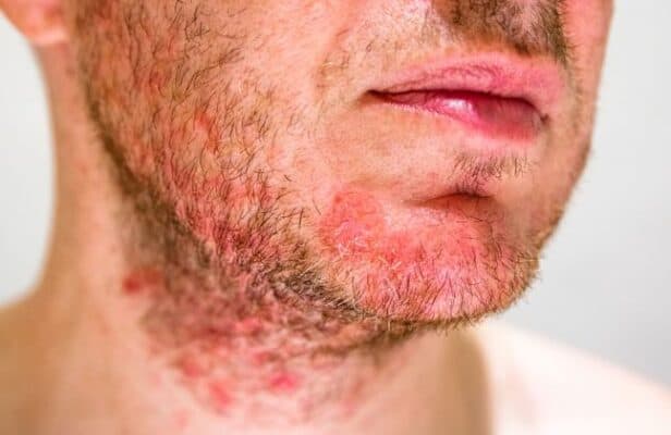 fungal acne fatal
